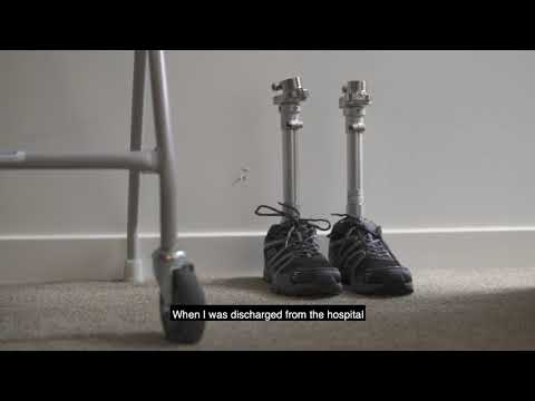 Picture of persons prosthetic legs with shoes on 